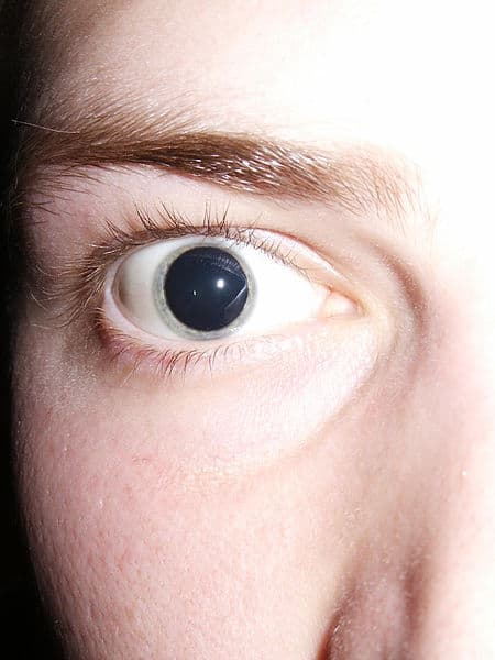 Dilated pupils